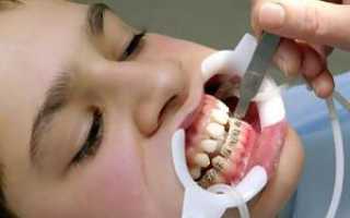 До какого возраста детям можно выравнивать зубы брекетами и стоит ли их ставить взрослому после 30 лет?