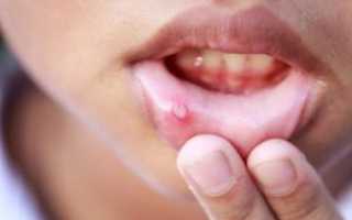 Как и чем лечить стоматит у взрослых в домашних условиях: народные средства для полоскания полости рта