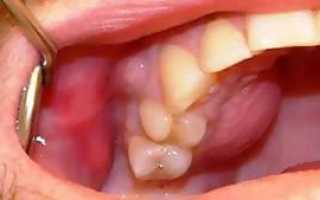 Симптомы воспаления надкостницы зуба: что это такое — фото и способы лечения периостита