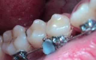 Почему может отклеиться брекет на зубе, и что делать, если возникла подобная ситуация?