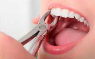 Можно ли лечить, удалять и пломбировать зубы во время месячных и применять анестезию?
