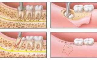 Что делать после процедуры удаления зуба мудрости на нижней челюсти: как долго заживает и сколько будет болеть лунка?